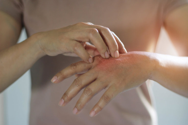 Woman nursing her dog bite.