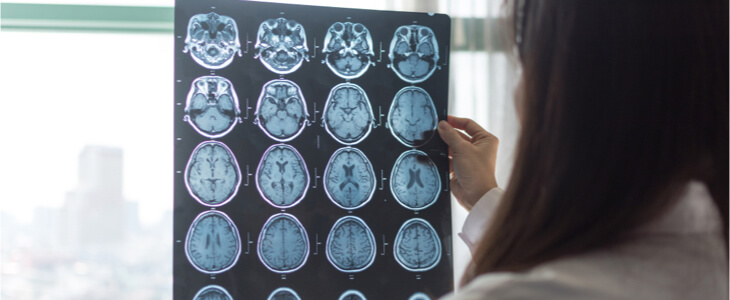 Doctor reviewing brains scans after an anoxic brain injury
