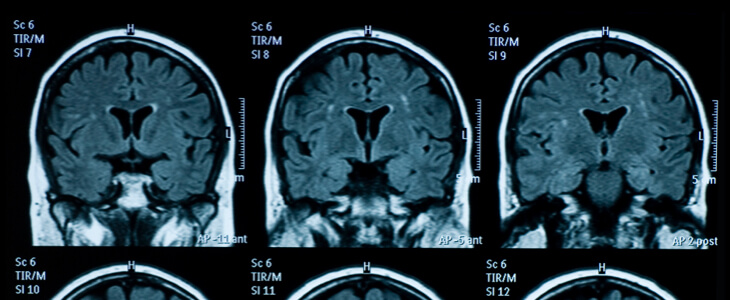 Patient brain scans after a truck accident