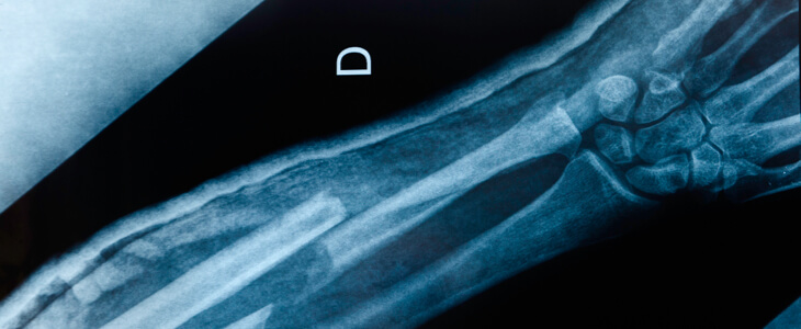 X-ray of a broken arm bon