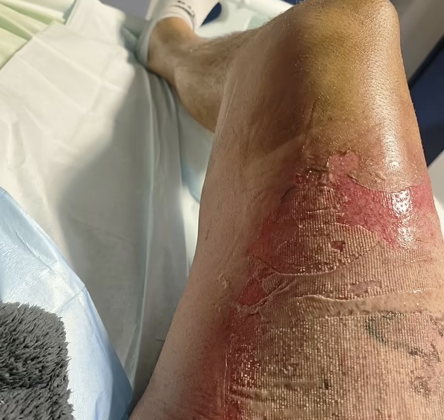 leg burn from exploding vape