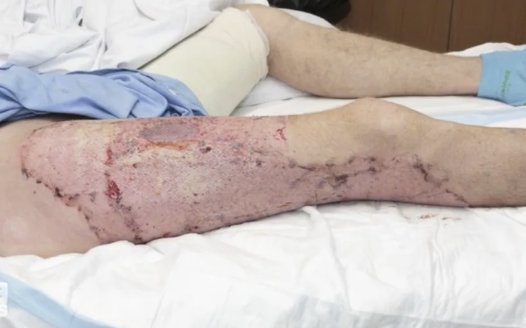 australian man needs skin grafts after vape explodes in his pocket