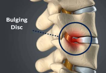 a graphic showing what a bulging disc looks like on the spine